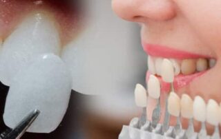 facette dentaire lumineers