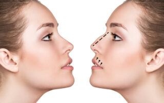 rhinoplastie ultrasonique tunisie