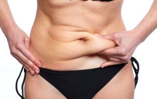 Gonflement après abdominoplastie