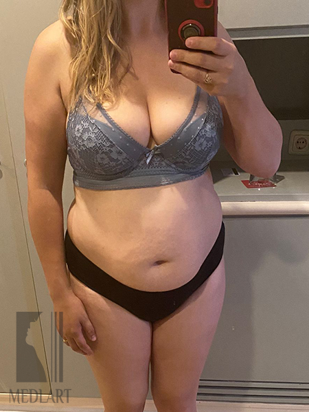 PAV-3 photo avant abdominoplastie medlart