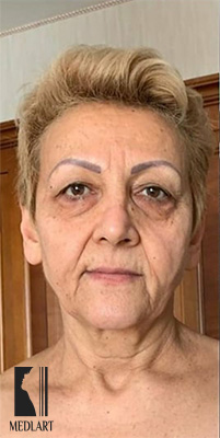 lifting visage Tunisie avant